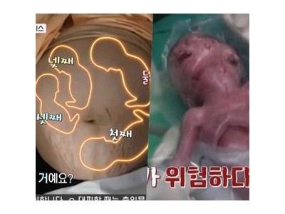국내 최초 네쌍둥이 출산 현장 모두 울지 않아 긴장감 높여 썸네일